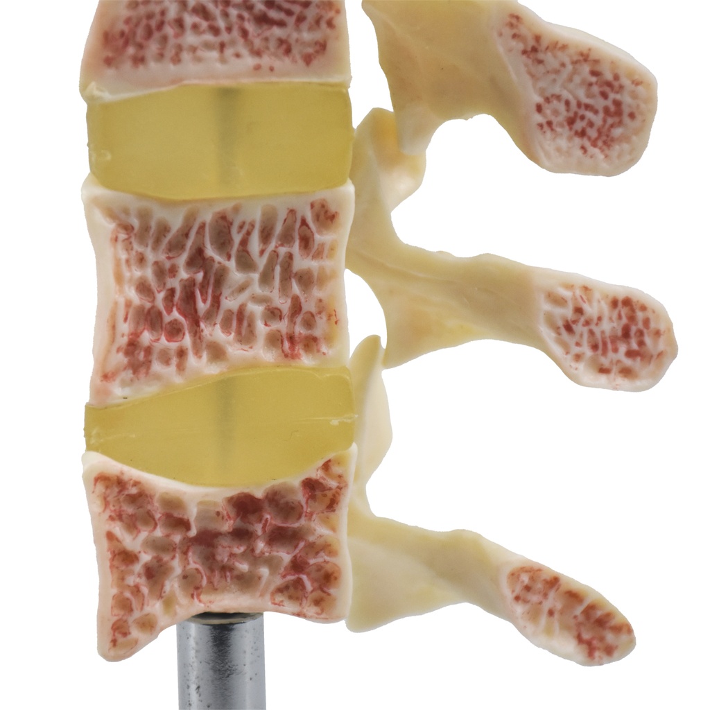 OSTEOPOROSIS-PREMIUM 4.jpg