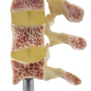 OSTEOPOROSIS-PREMIUM 4.jpg