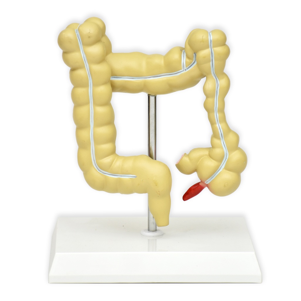 Modelo de intestino grueso enfermo