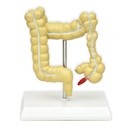 Modelo de intestino grueso enfermo