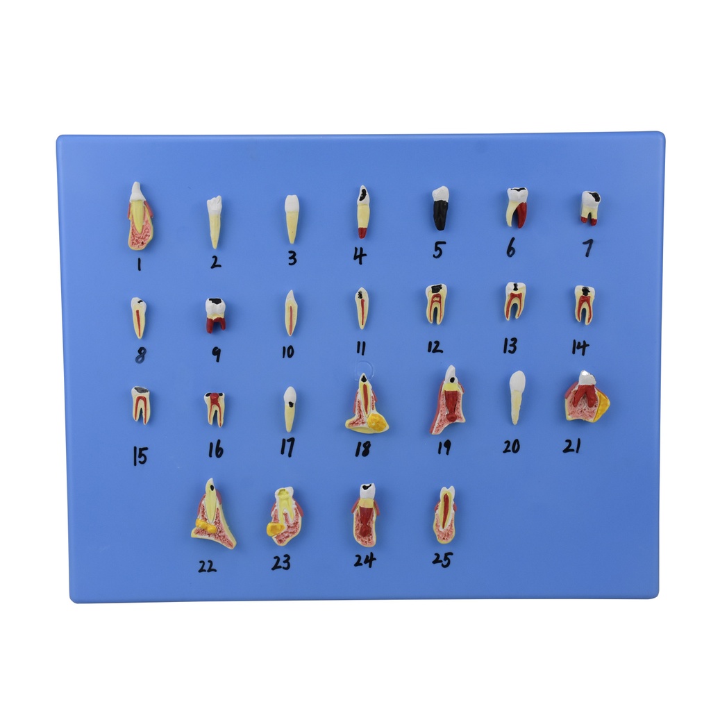 Modelo de dientes con padecimientos