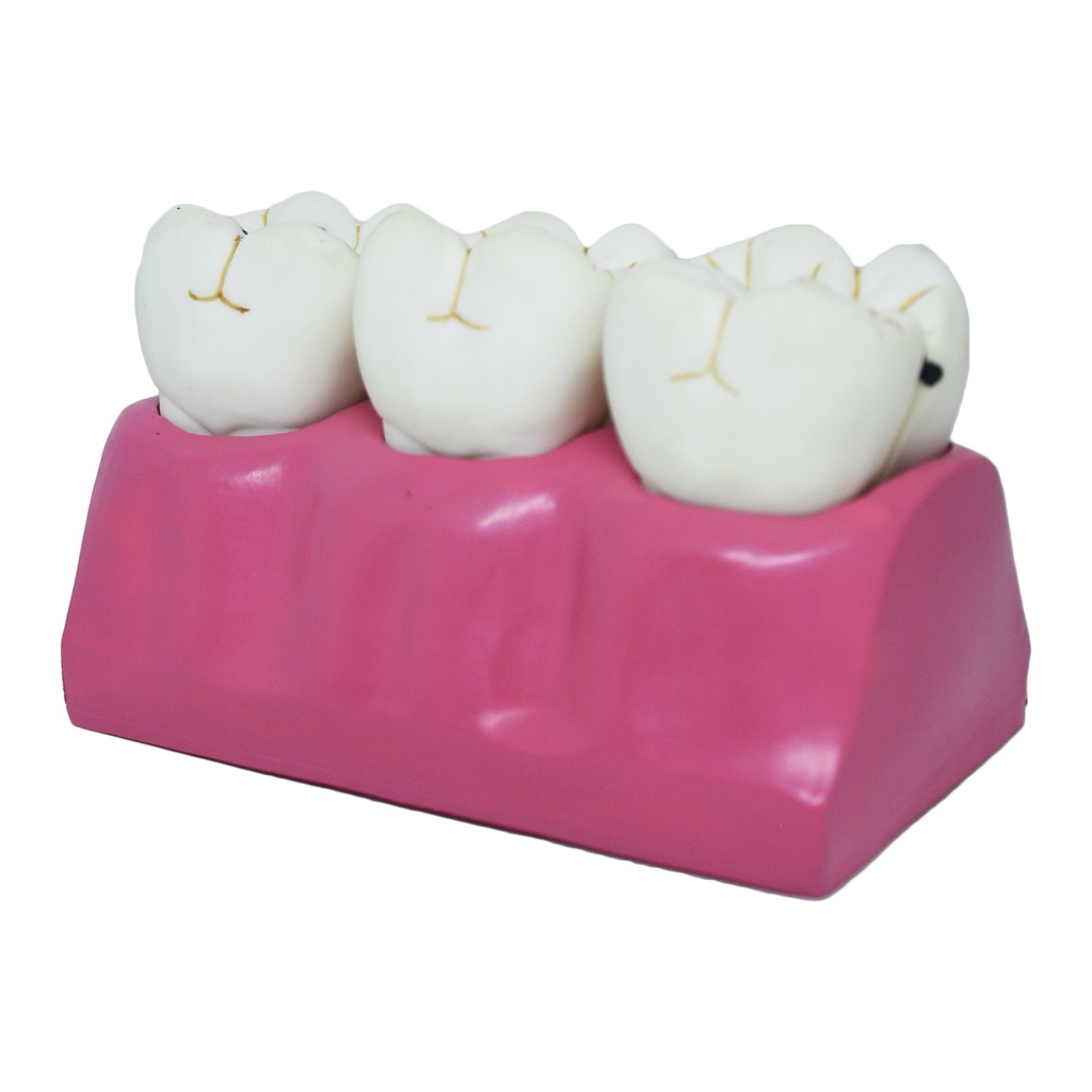 Modelo dental de caries