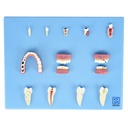 Modelo de enfermedades dentales