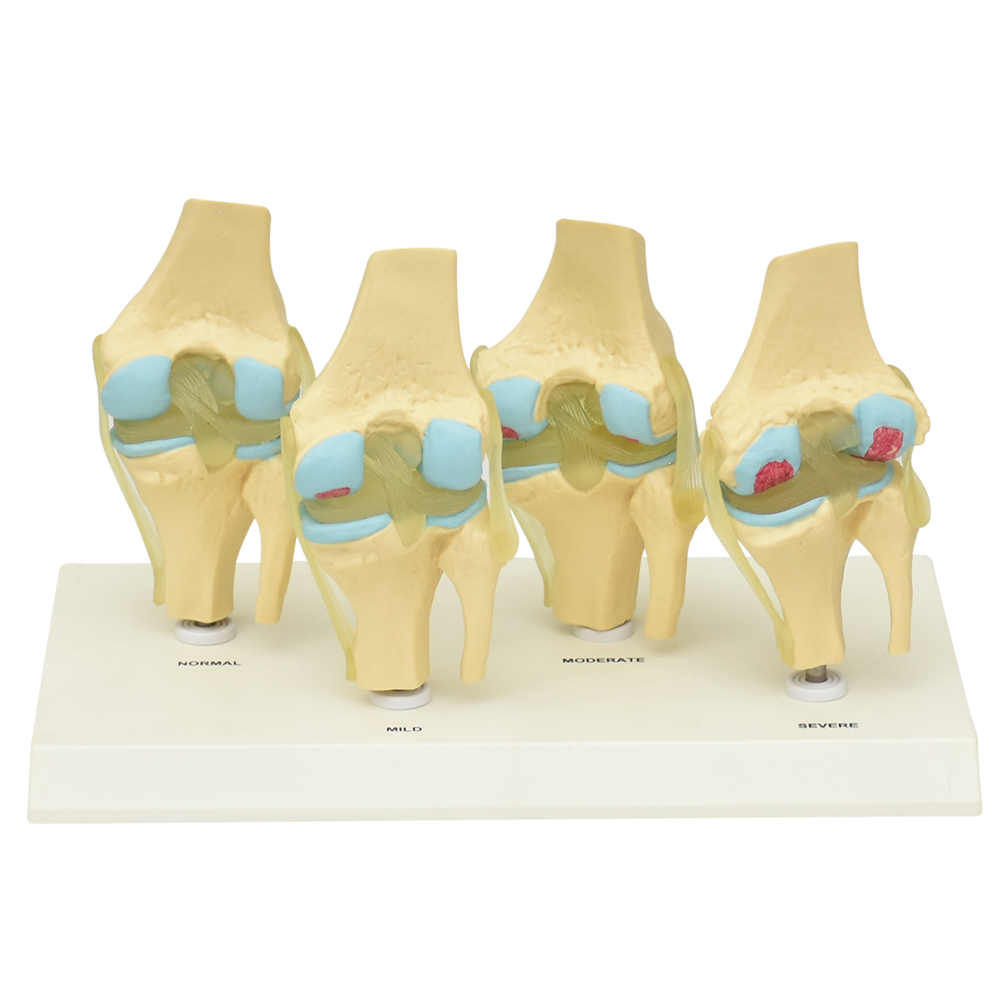 Modelo anatómico de 4 etapas de desgaste de rodilla
