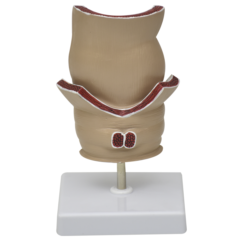 Modelo de recto con patologías