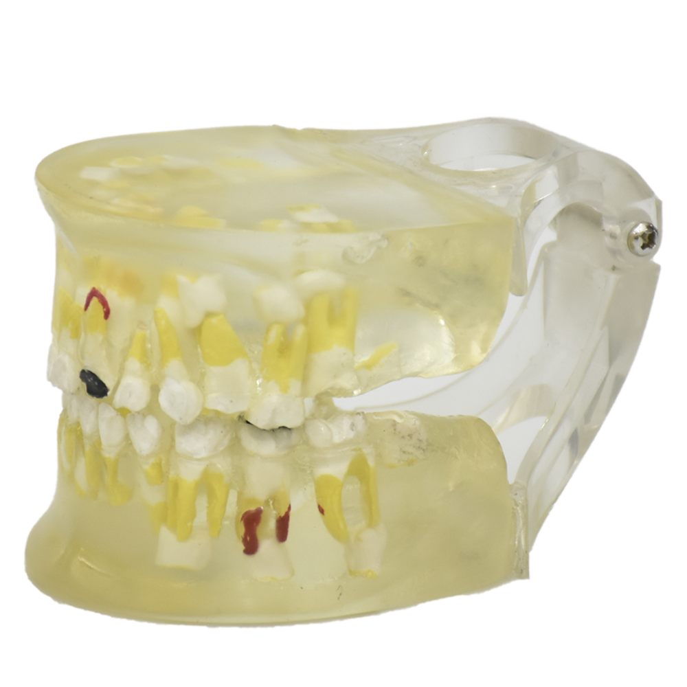 Modelo de patología dental transparente
