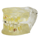 Tipodonto patología de dientes de leche transparente