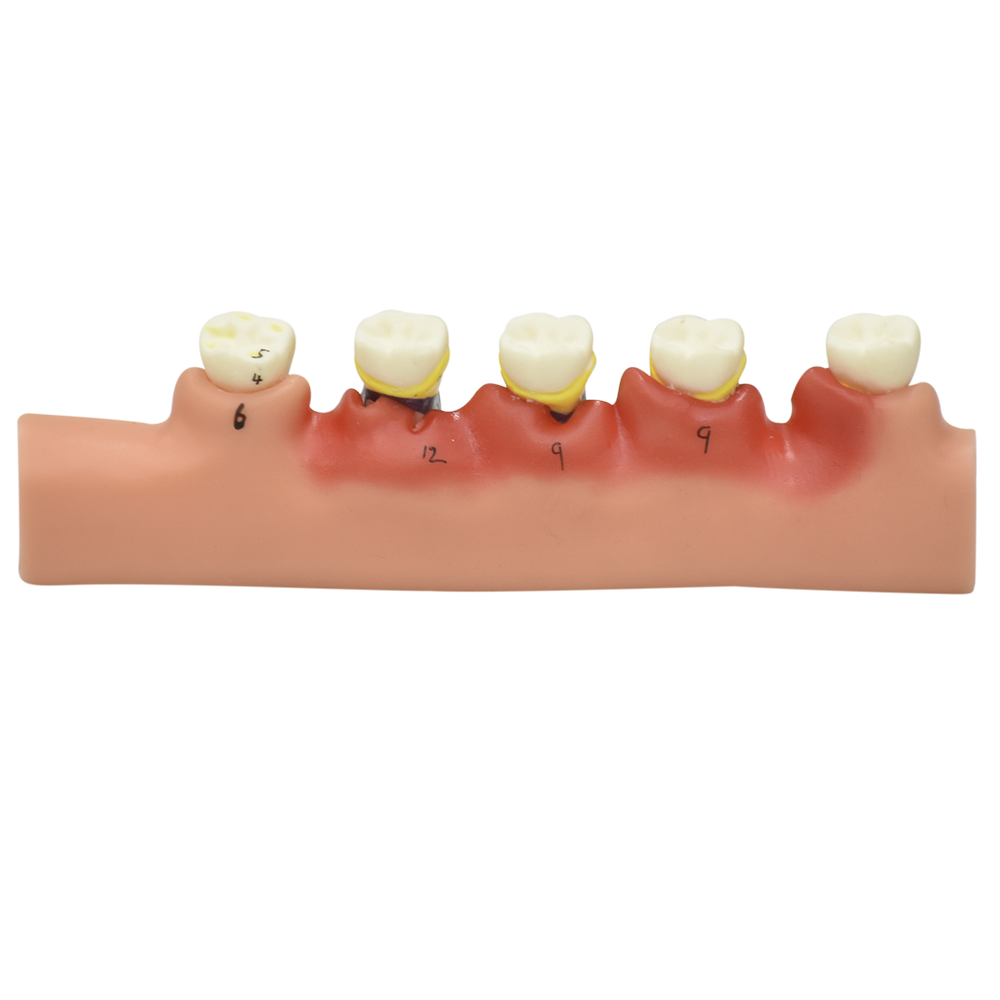 Modelo anatómico de enfermedades periodontales