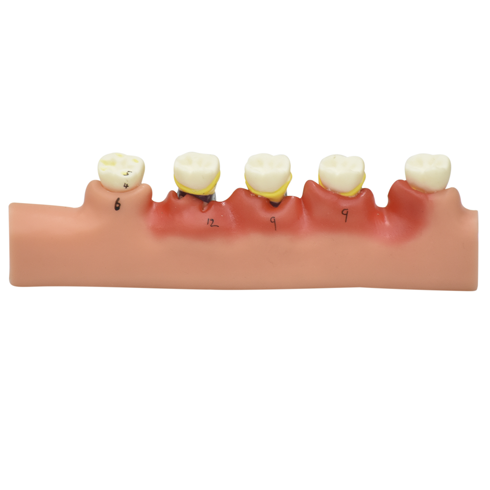 Modelo anatomico de enfermedades periodontales