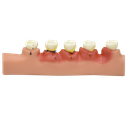 Modelo anatómico de enfermedades periodontales