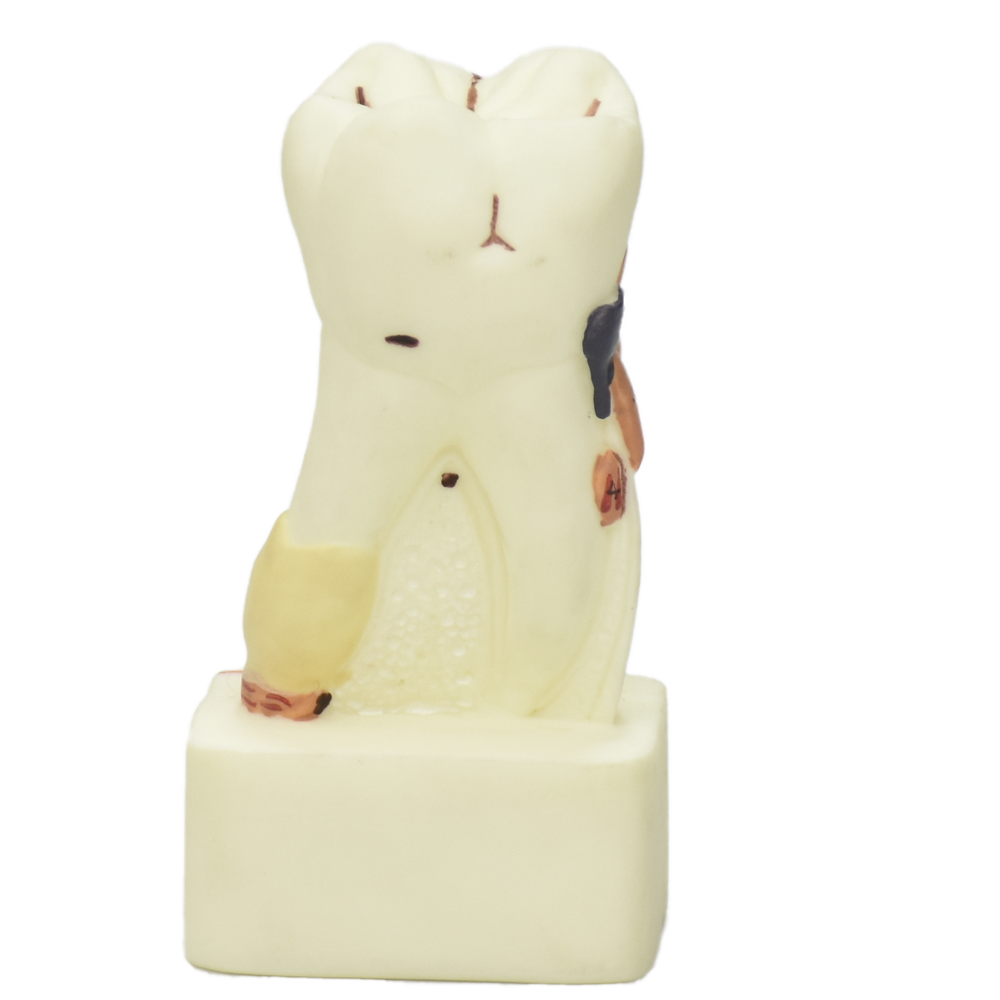 Modelo de molar con padecimientos