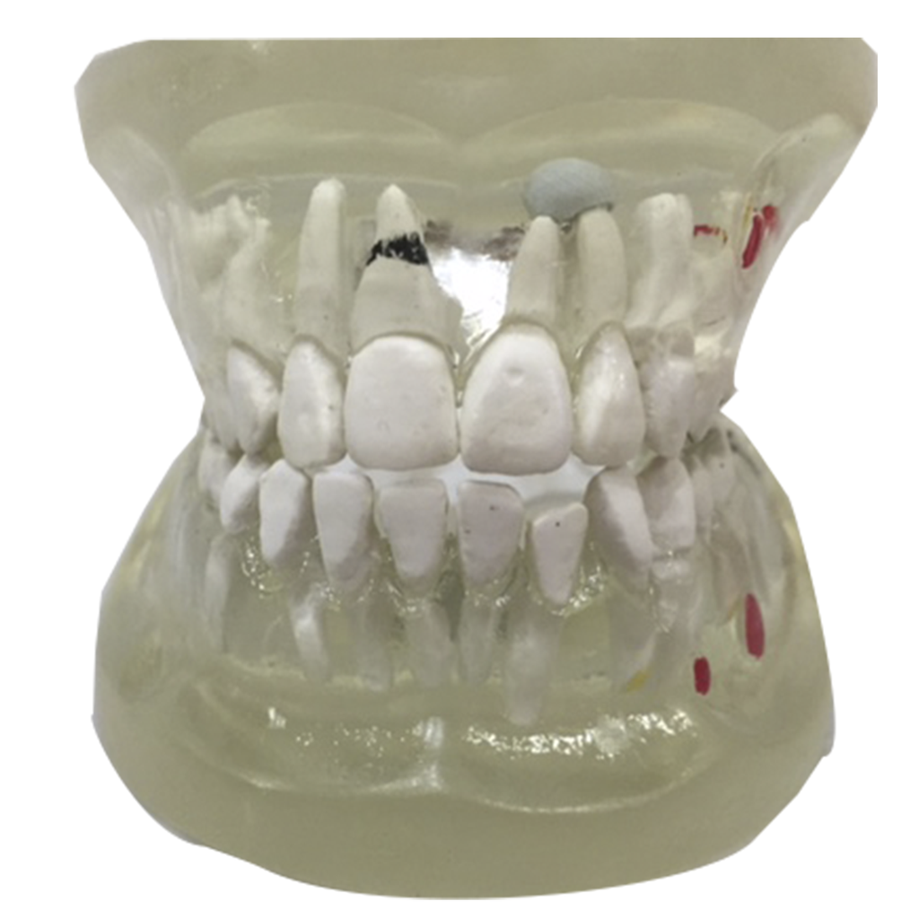 Mandíbula con patologías dentales