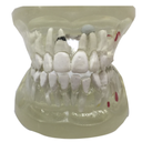 Mandíbula con patologías dentales