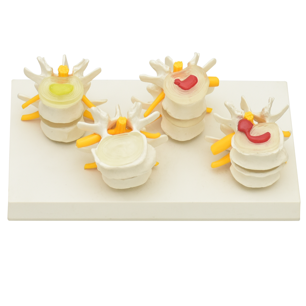 4 etapas de vertebras enfermas