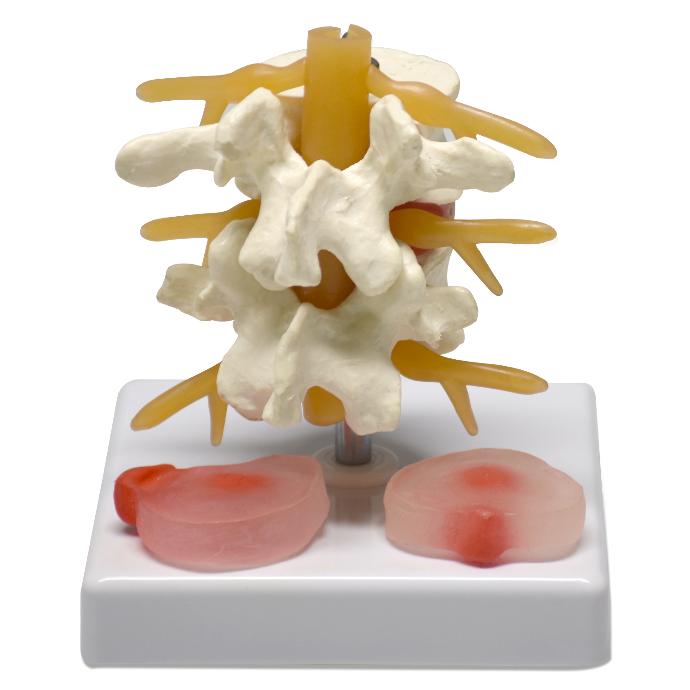 Vertebras con disco herniado