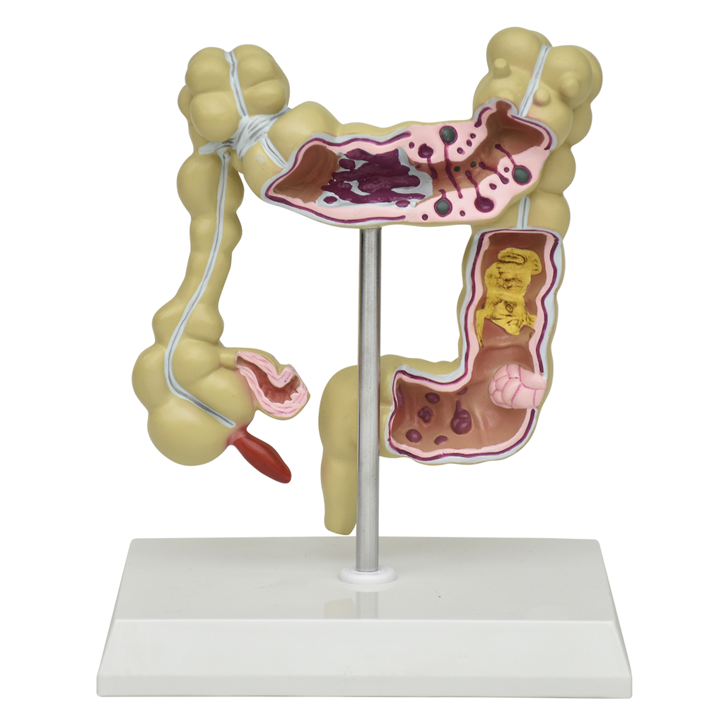 Modelo de intestino grueso enfermo