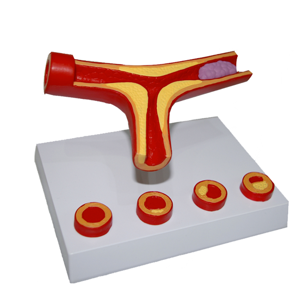 MODELO DE ARTERIOSCLEROSIS