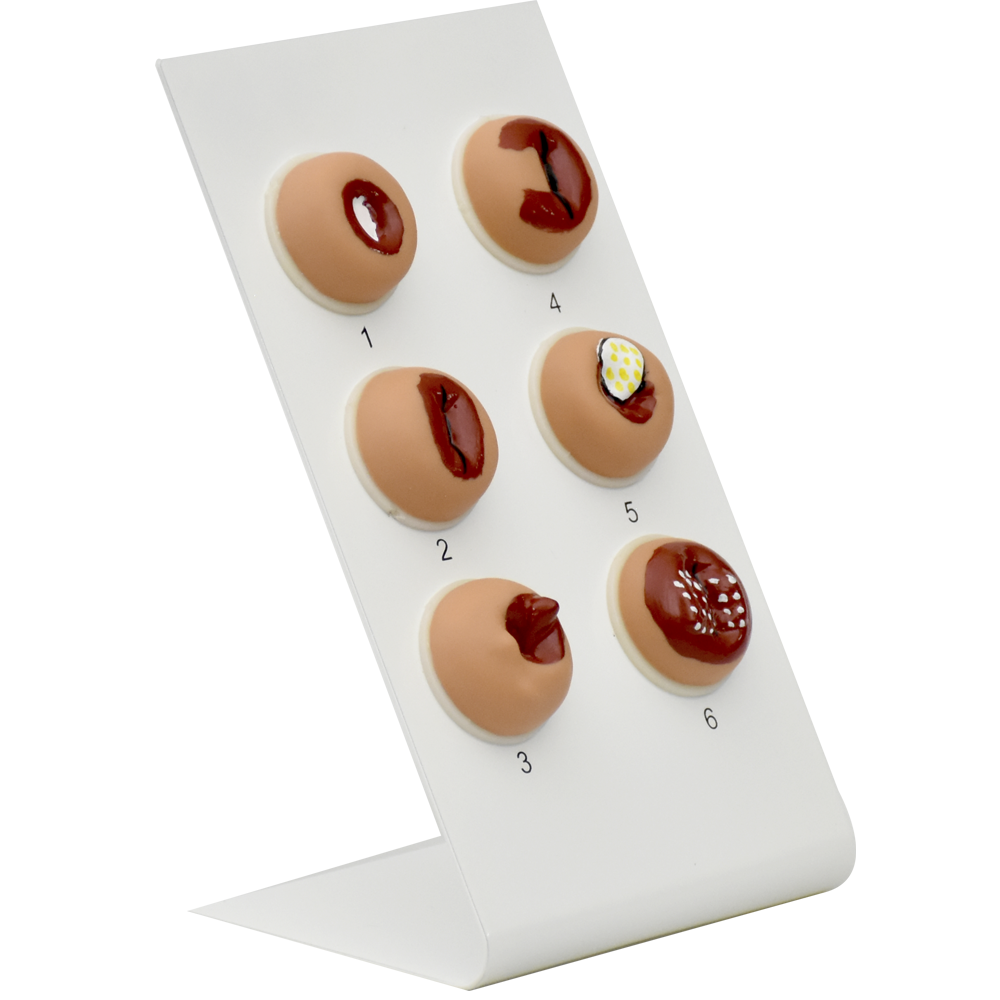 Modelo de lesiones en cervix