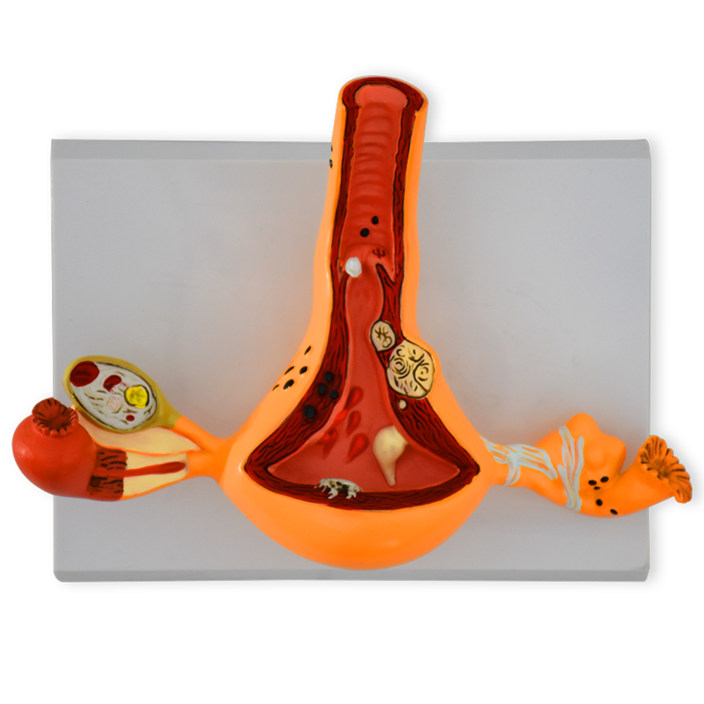 Utero con patologias