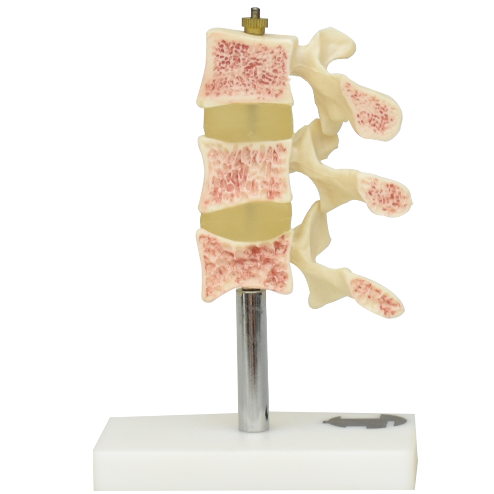 Osteoporosis de lujo