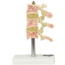 Osteoporosis de lujo