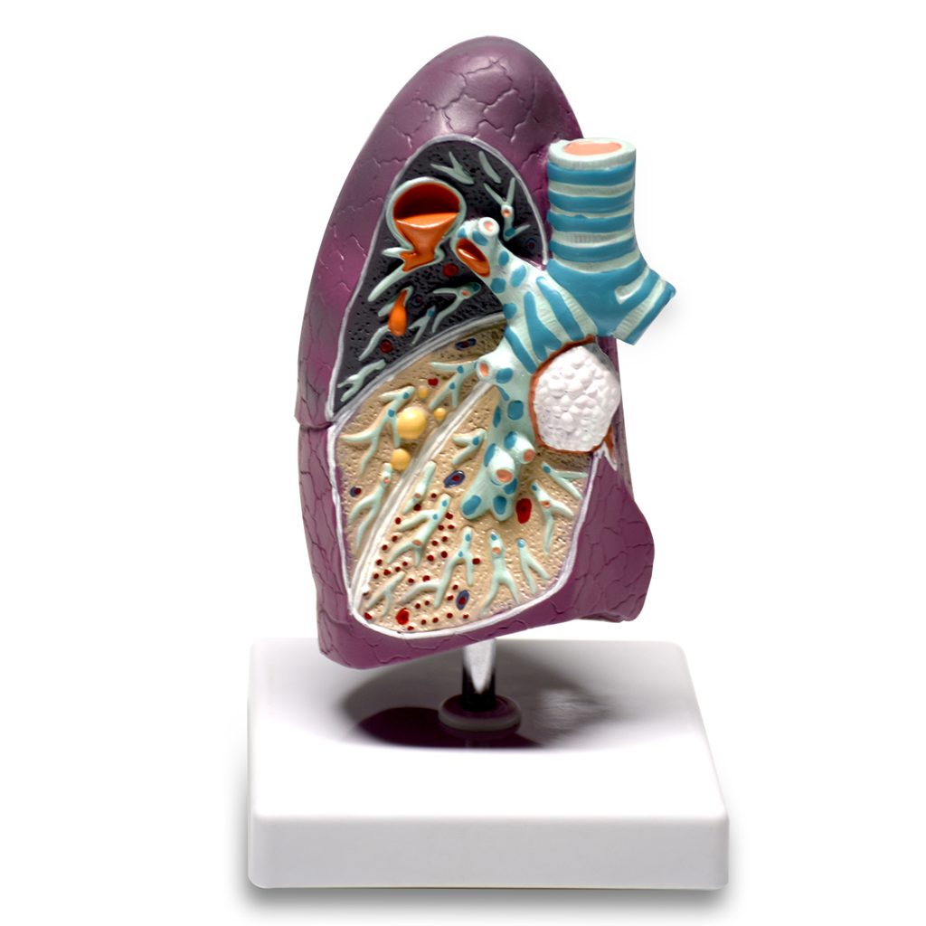 Modelo de pulmón con patologías