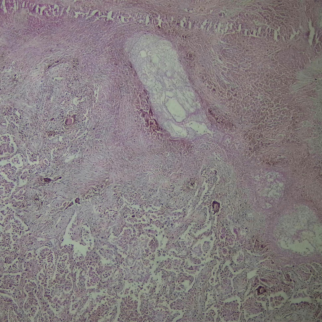 Preparación microscópica de pulmones dañados por tuberculosis