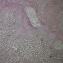 Preparación microscópica de pulmones dañados por tuberculosis
