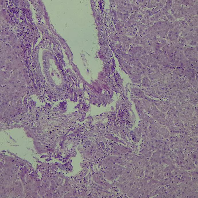 Preparación microscópica de degeneración de células hepáticas por cirrosis