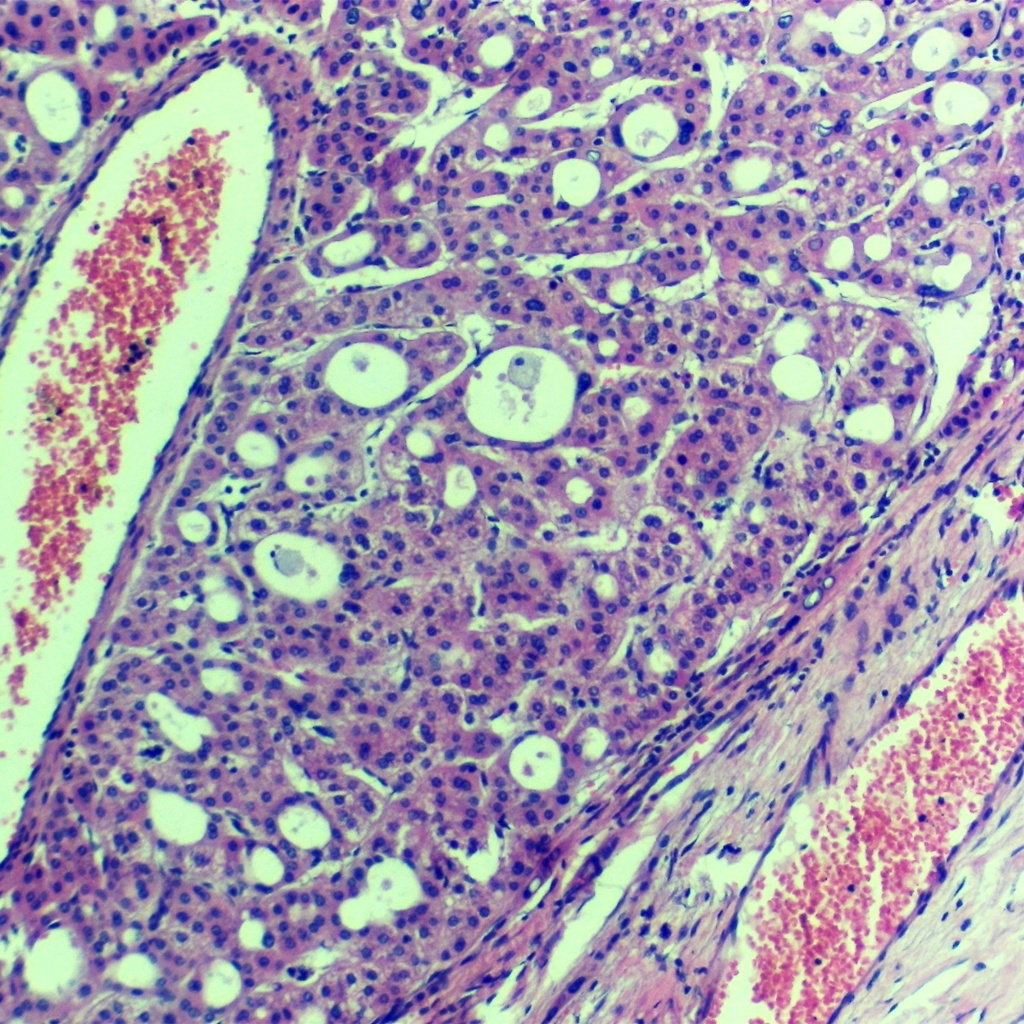 Preparación microscópica de células cancerígenas en hígado