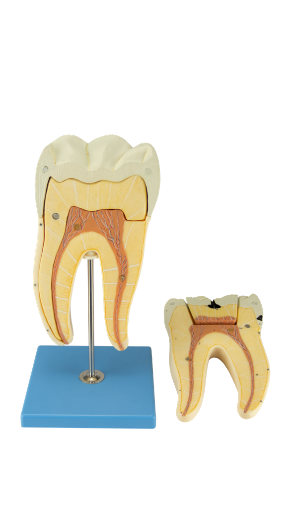 Modelo de diente cariado