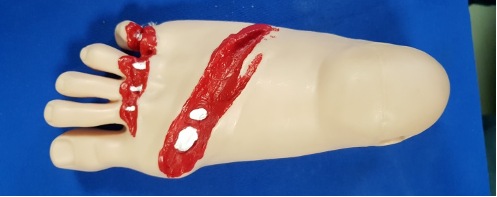 Fractura expuesta para trauma