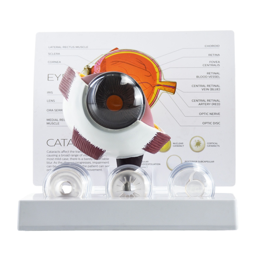 Modelo de ojo con catarátas