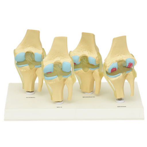 [ROD-4] Modelo anatómico de 4 etapas de desgaste de rodilla