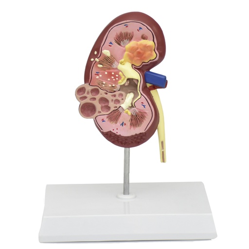 [KIDNEY-ENF] Riñón enfermo