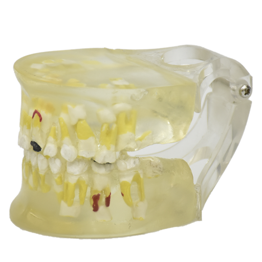 [DEN-PAT-LECHE] Modelo de patología dental transparente