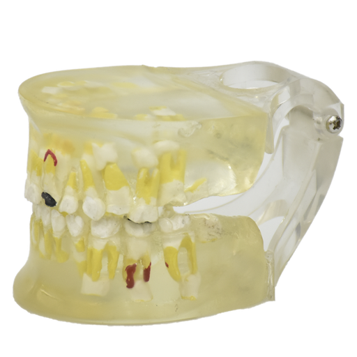 [DEN-PAT-LECHE] Modelo de patologia dental transparente
