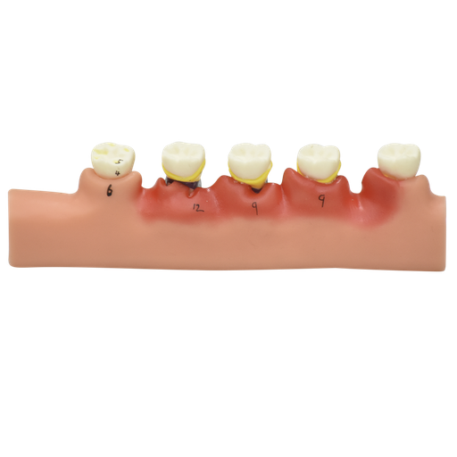 [DIE-PERI-ENF] Modelo anatómico de enfermedades periodontales