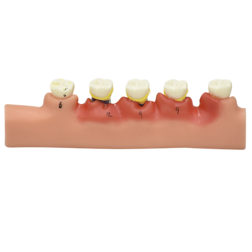 [DIE-PERI-ENF] Modelo anatomico de enfermedades periodontales