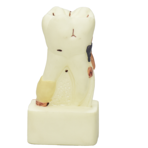 [MOL-ENF] Modelo de molar con padecimientos