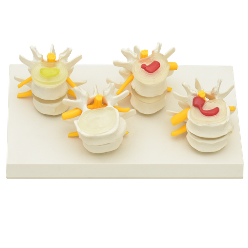 [VERT-ENF4] 4 etapas de vertebras enfermas