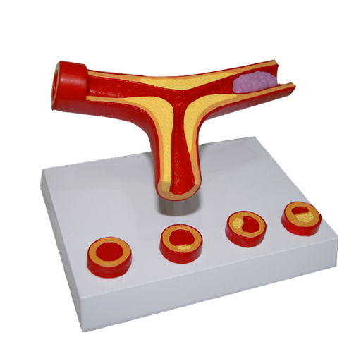 [ARTE] MODELO DE ARTERIOSCLEROSIS