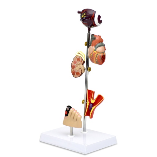 [DIABETES] Modelo de diabetes