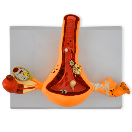 [UTERO-PAT] Útero con patologías