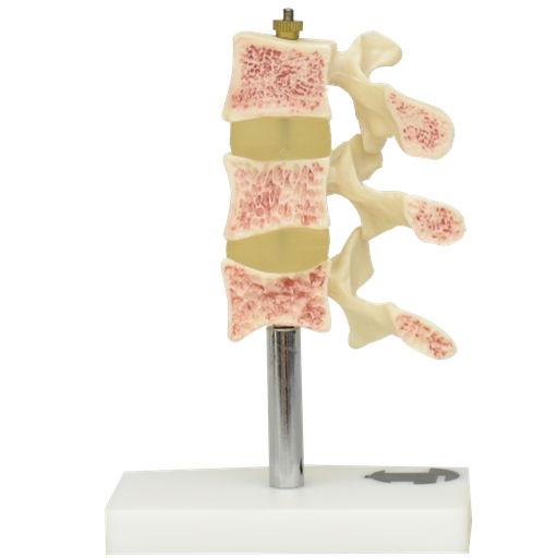 [OSTEOPOROSIS-PREMIUM] Osteoporosis de lujo