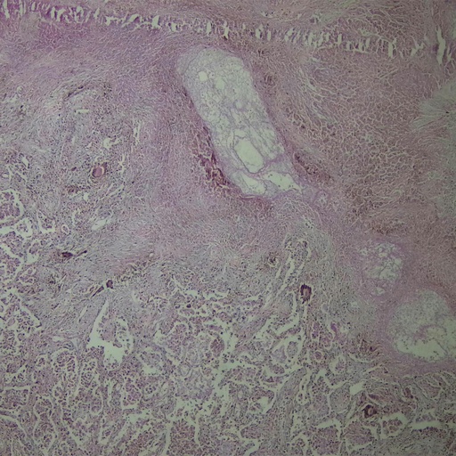 [PR-M59] Preparación microscópica de pulmones dañados por tuberculosis