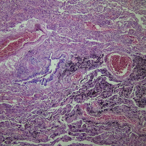 [PR-M60] Preparación microscópica de pulmones dañados por fumar