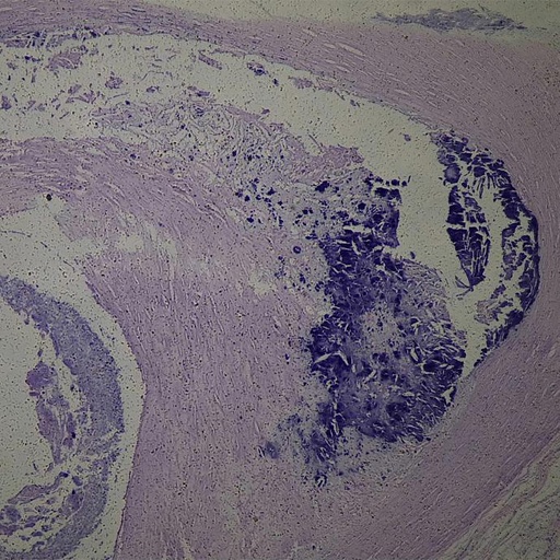 [PR-M62] Artereoesclerosis en arterias, cambios de los vasos