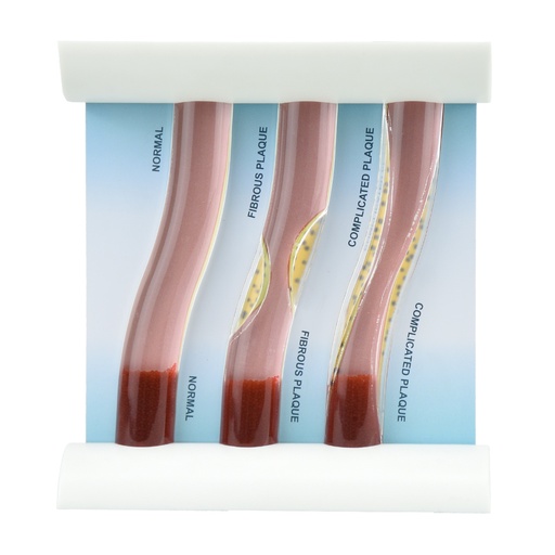 [BLOOD-ATERO] Modelo dinámico de vasos sanguíneos, normal y aterosclerosis