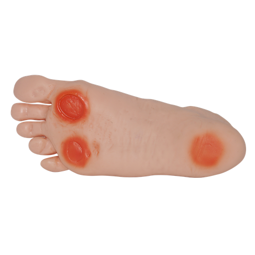 [PIE-DIAB] Pie diabético